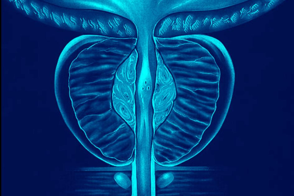 Crecimiento de próstata o hiperplasia prostática benigna