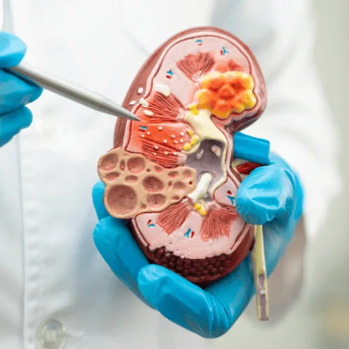 Hiperplasia prostática: Diagnóstico y tratamiento experto en CDMX